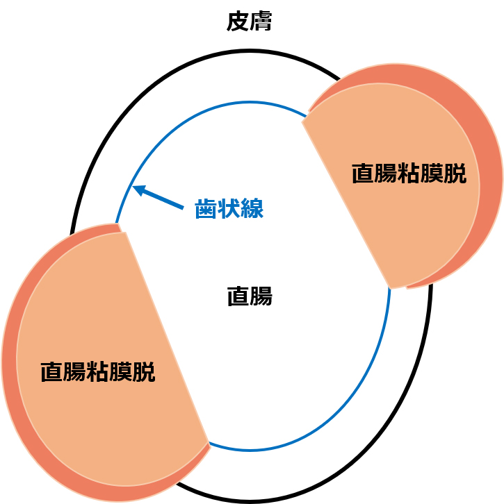 直腸粘膜脱
