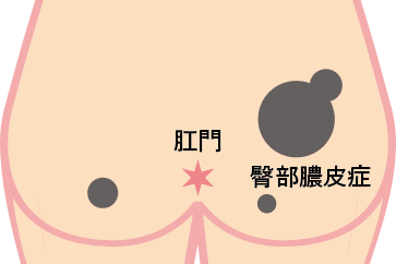 殿部膿皮症