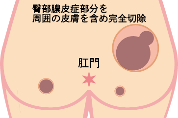 殿部膿皮症の治療