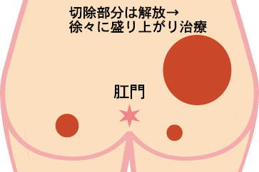 殿部膿皮症の治療