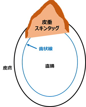 スキンタグ